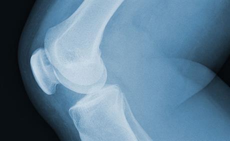 Može li bez operacije koljena?