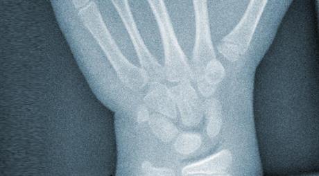 Udarni val za pseudoartrozu