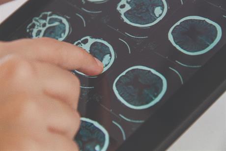 Što ugrožava mozak?