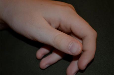 Nije svaki nesretan slučaj osigurani slučaj