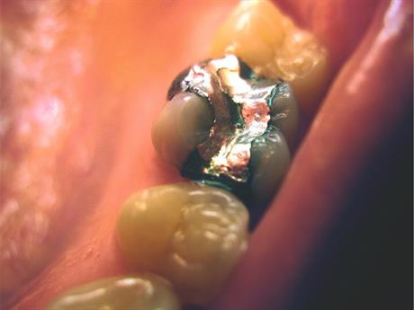 Djelomična zabrana amalgamskih plombi