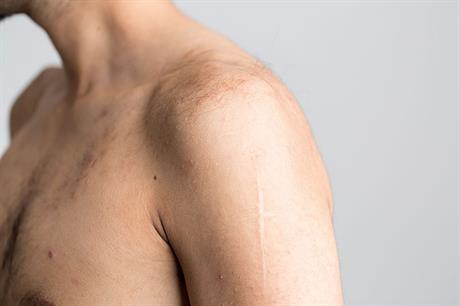 Protruzija, ligamenti, lordoza