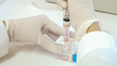 Zašto liječiti osteoartritis i oštećenja hrskavice matičnim stanicama