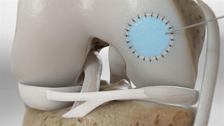 Transplantacija i presađivanje hrskavice
