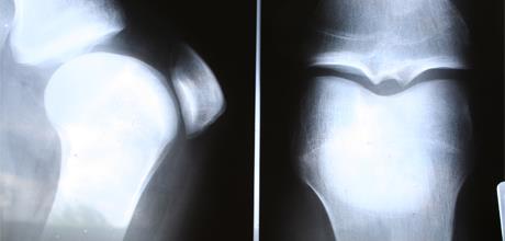 Omekšanje hrskavice