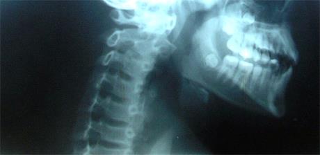 Kako  vještaci utvrđuju posljedice ozljeda?