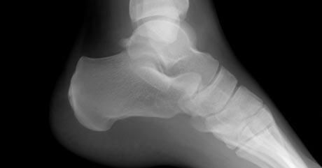 Komplikacije po distorziji gležnja