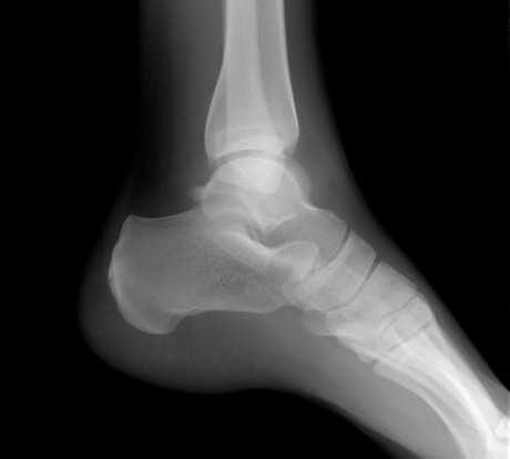 Problemi sa zglobovima – upala sinovije