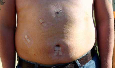 Kada operirati žučne kamence?