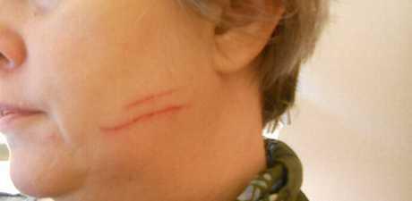 Nema naknade za neznatne ozljede