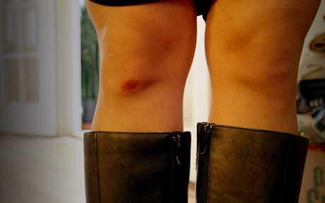 Ozljede patele u sportu