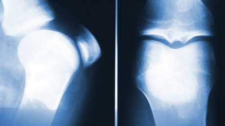 Oporavak nakon artroskopije koljena