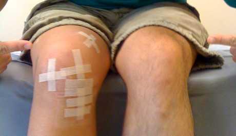 Vježbe nakon operacije meniskusa