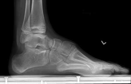 Bol zbog kalcifikata u peti