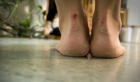 Upala ligamenta u stopalu