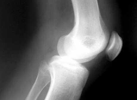 Oporavak nakon meniscektomije